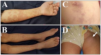 A Syrian Refugee in Iraq Diagnosed as a Case of IL12RB1 Deficiency in Japan Using Dried Blood Spots